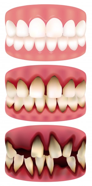 Gingivitis and periodontitis