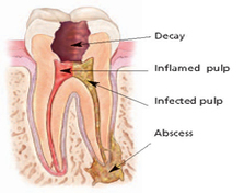 Root_Canal_3