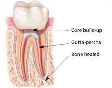 Root_Canal_2