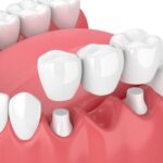 Crown and Bridge Dental Services